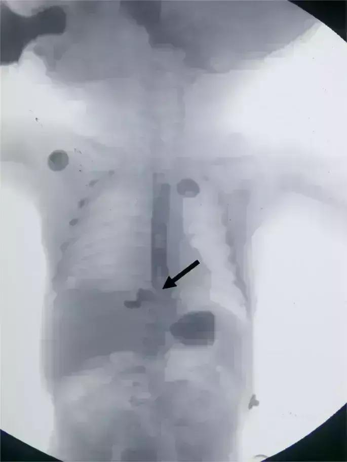 Rare Case Of Neonatal Idiopathic Esophageal Perforation Reported