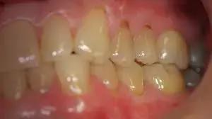 Nevus- Most Prevalent Pigmented Oral Lesion, Finds New Study