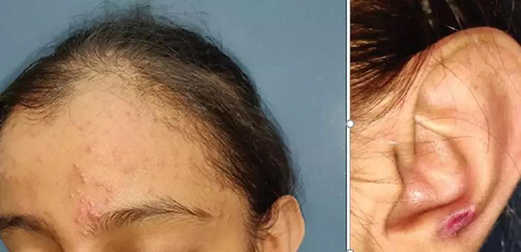 Turban Triad- Entity That Highlights Role Of Cultural Factors In Certain Skin Diseases