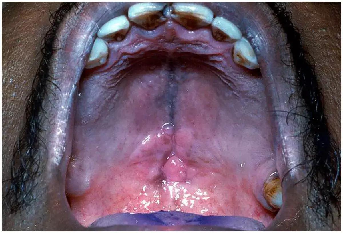 Mucoadhesive Antifungal Delivery Vehicles As Effective As Topical Agents For The Treatment Of Oral Candidiasis: Study