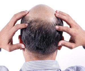 43 Year Old Dies After Hair Restoration Surgery, Dermatologist Under Radar