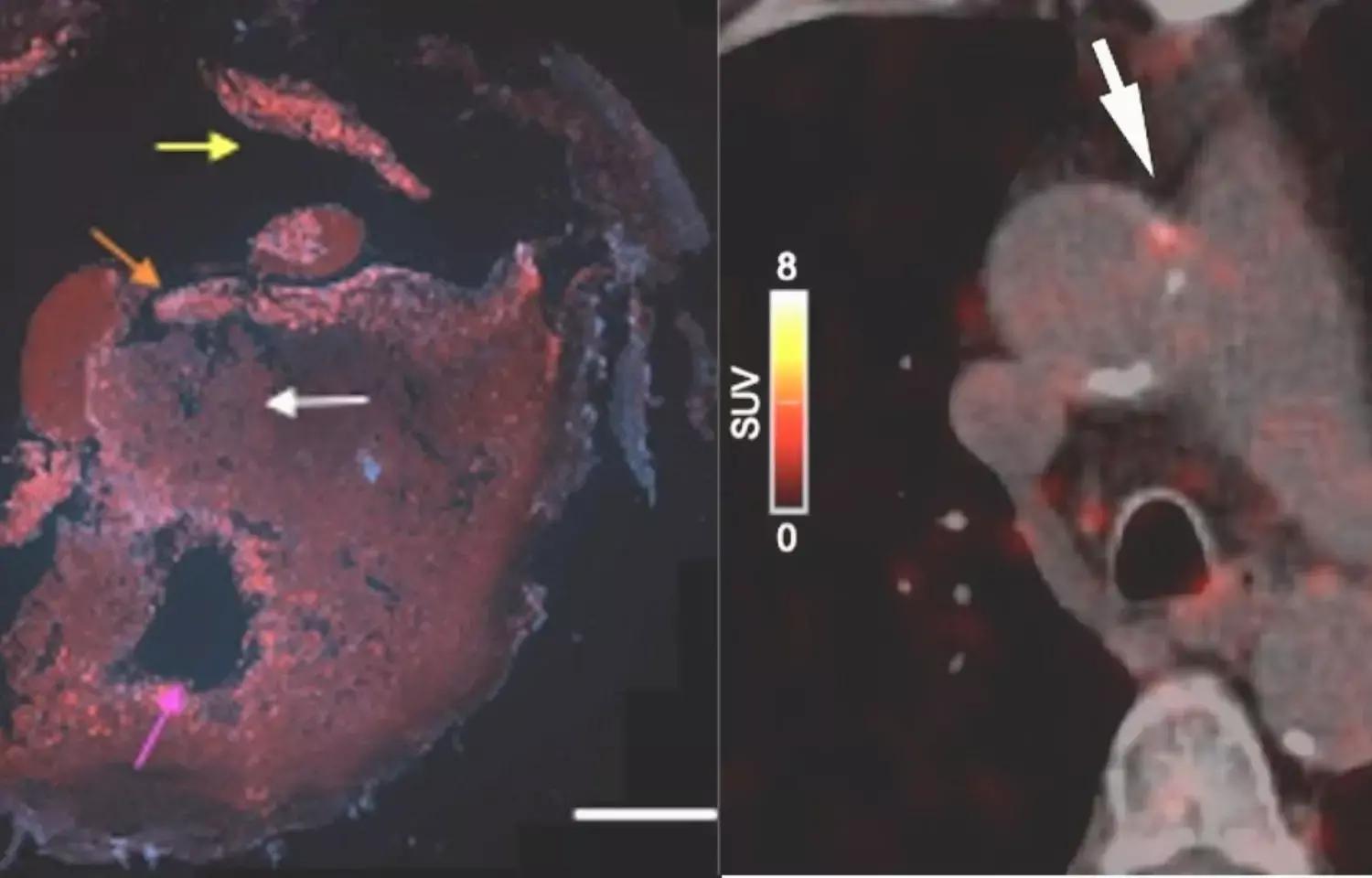 Novel PET Radiotracer Can Help In Early Diagnosis Of Atherosclerosis: Study