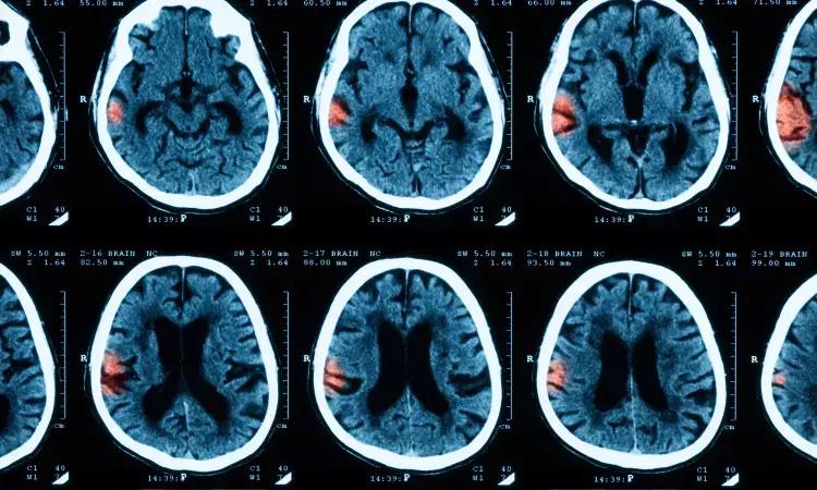 High BP Reported Among ICH Survivors After Treatment Of Depression With SNRIs And SSRIs