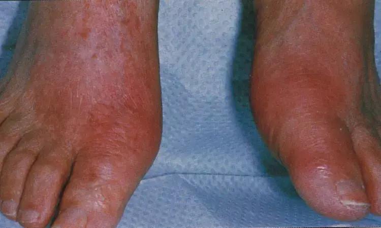 Meta-Analysis Suggests Benefit Of Electroacupuncture In Acute Gouty Arthritis