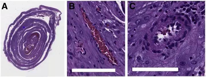 Case Reports Of Severe Placental Abruption As A First Symptom Of Preeclampsia: Hindawi