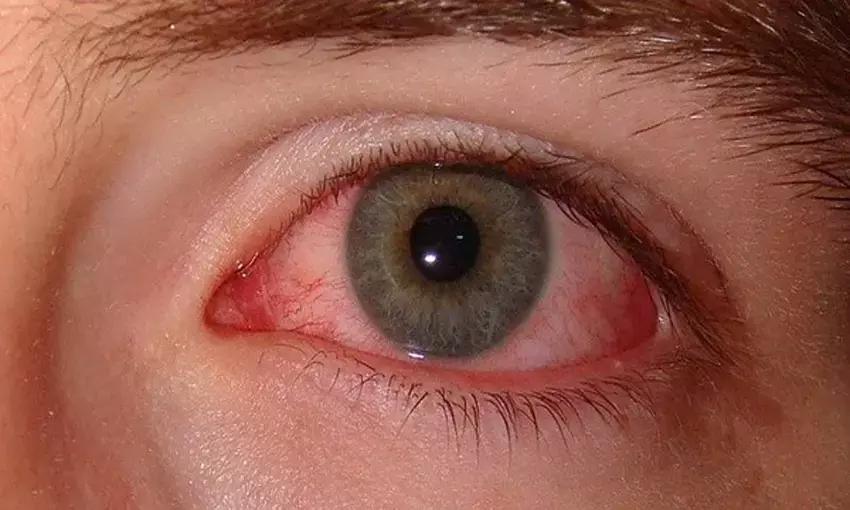 Acupuncture Effective For Treating Dry Eye After Refractive Surgery: Study