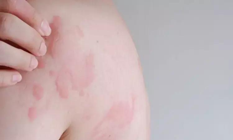 Rare Case Of Rosai-Dorfman Disease In Woman With Cervical Cancer And Syphilis: A Report