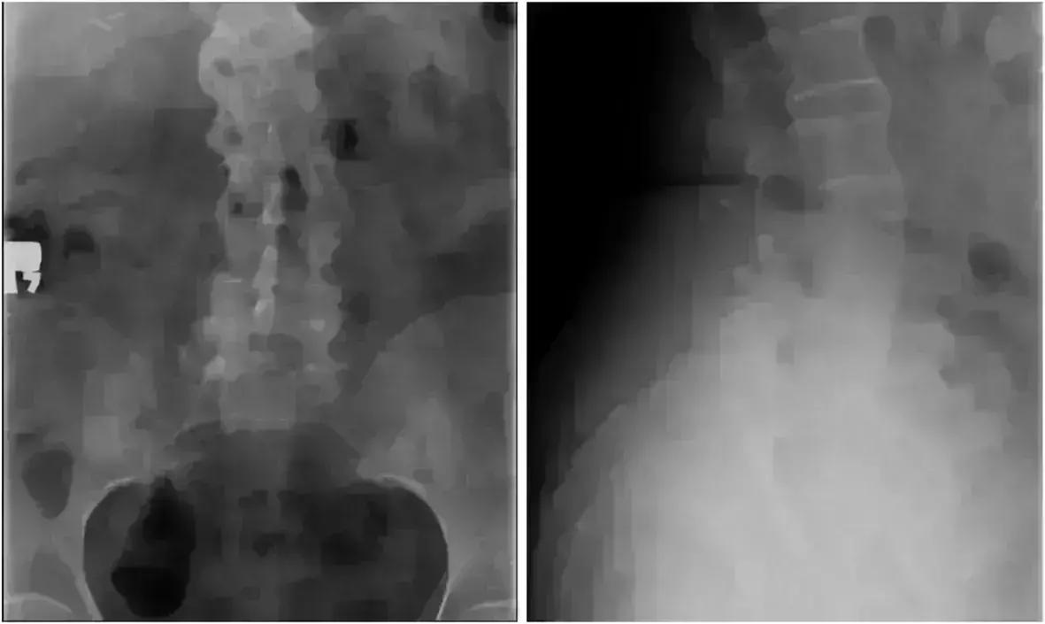 Manifestation Of Ankylosing Spondylitis After Kidney Transplant: A Case Report