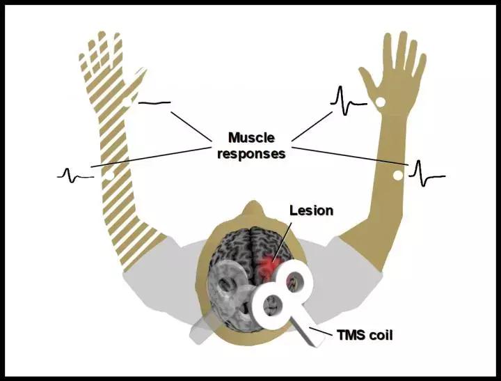 Structural Integrity Of Corticospinal Tract Best Predictor For Upper Limb Motor Recovery