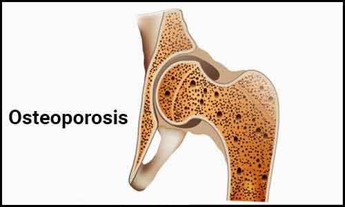 Romosozumab Substantially Builds Bone Mineral Density In Hip And Spine