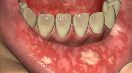 Which Are The Factors That Lead To Severity Of Oral Mucositis After Radiotherapy For Head And Neck Cancer?