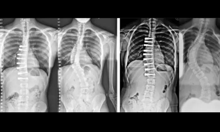 Nighttime Bracing Outperforms Physical Activity Alone In Preventing Progression Of Adolescent Idiopathic Scoliosis: Study
