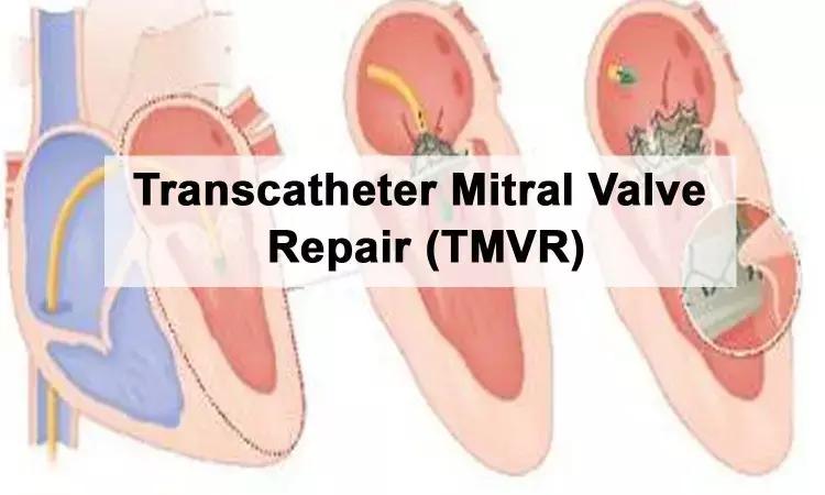 Transcatheter Valve-In-Valve Or Redo Surgical Mitral Valve Replacement, Which Is Better In Failed Mitral Bioprostheses?