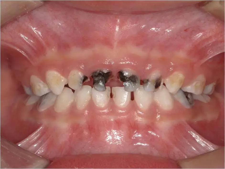 Cavitated Carious Lesions More Common In Maxillary Incisors And Molars In Both Arches In Preschool Children, Finds Study