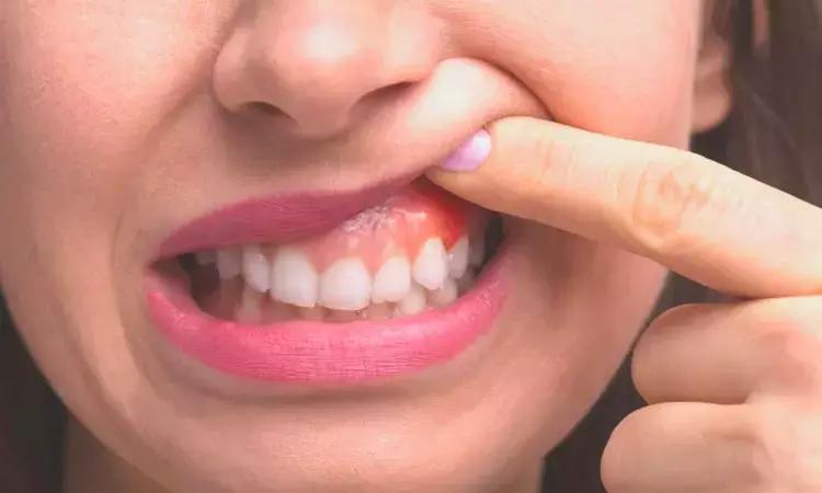 Periodontitis Imparts Greater Risk Of Developing Ischemic Stroke In Future Among Patients With High BP