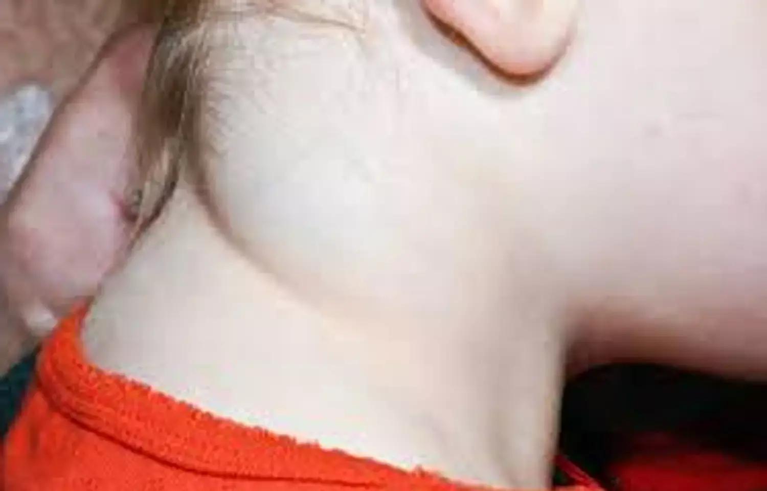 Bleomycin Sclerotherapy May Be An Effective Therapy For Lymphangiomas: Study