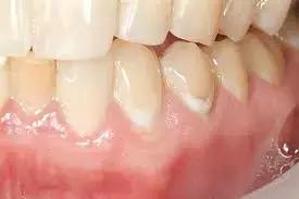 Varnishes Containing 40% S-PRG Filler Effective For Enamel Caries Remineralization: Study