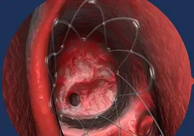 Corticosteroid-Eluting Sinus Stents Tied To Post Operative Infections, Finds Study