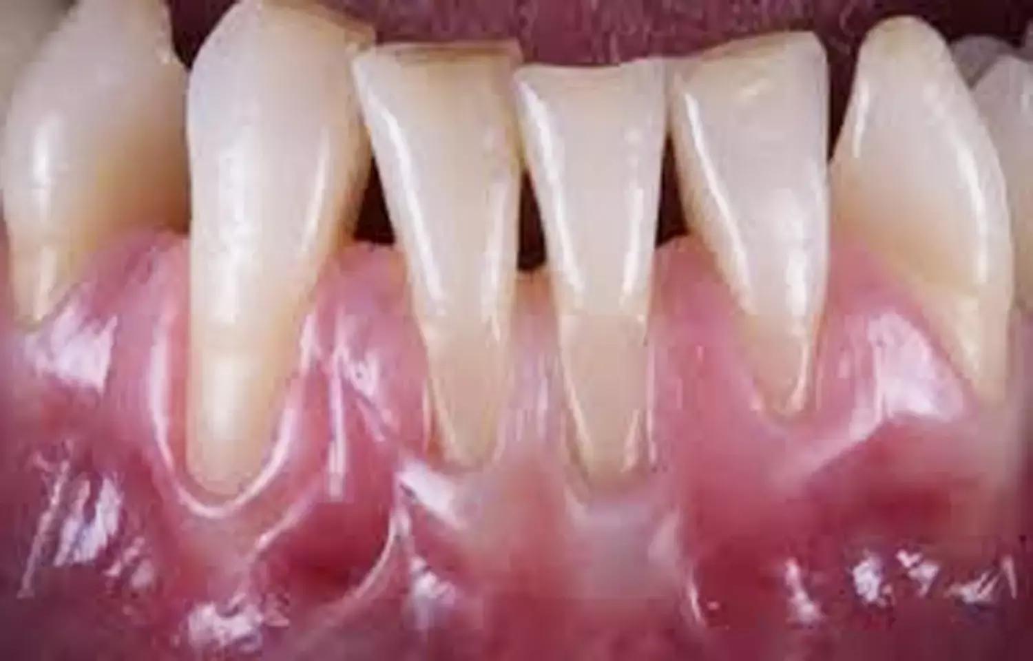 CAF, Tunnelling Procedures With CTG Effective Surgical Option For Gingival Recession: Study