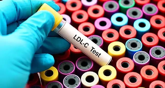 Small Dense LDL Cholesterol Promising Marker For Detecting Type 2 Diabetes