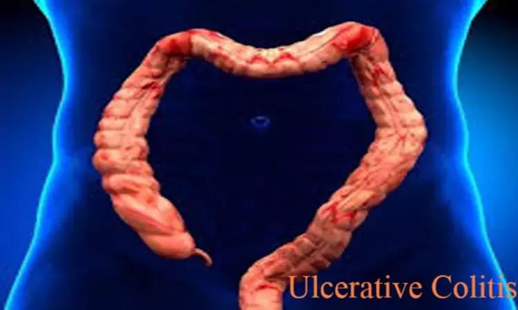 Thiopurine Monotherapy Effective In Ulcerative Colitis, Finds Study