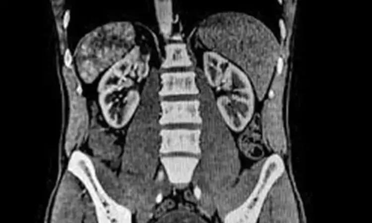 Mining Of Body Composition From Abdominal CT Using AI Can Predict Risk Of CVD, Fracture And Death