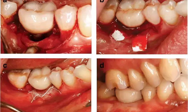 Flapless Surgical Approach Viable Surgical Treatment Alternative For The Management Of Peri-Implantitis: Study
