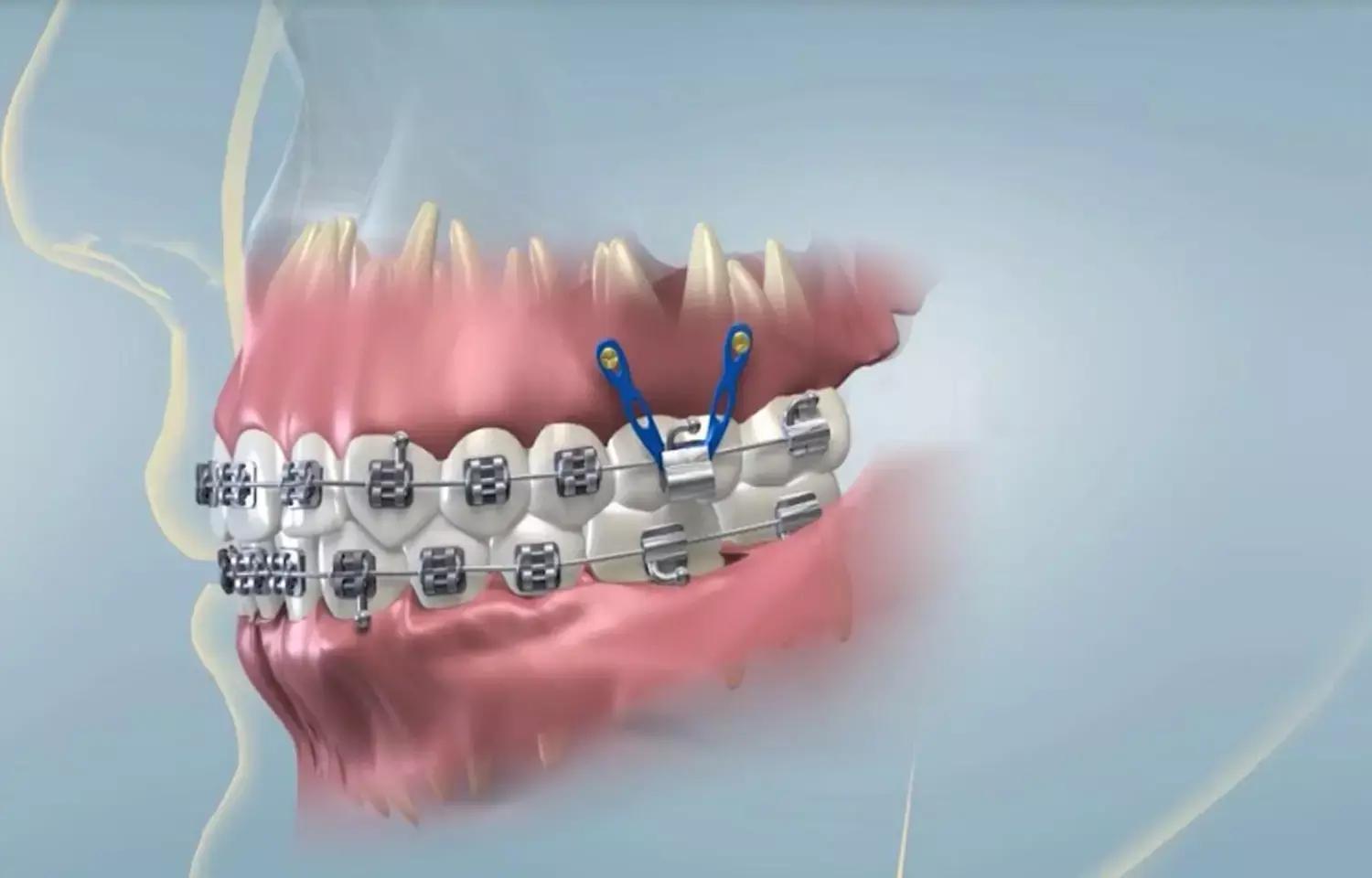 Spontaneous Repair Of Iatrogenic Root Perforation By An Orthodontic Miniscrew- A Case Report