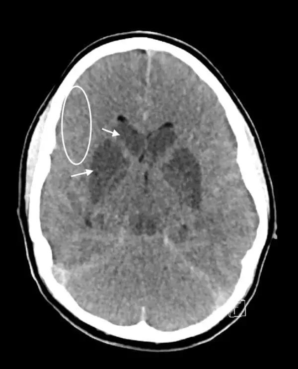 Noncontrast CT Sufficient For Identifying Patients Of Acute Ischaemic Stroke Likely To Benefit From Endovascular Thrombectomy