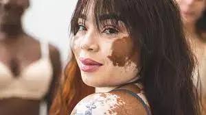 308-Nm LED Safe And Effective Treatment For Vitiligo Of Face: Study