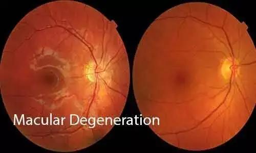 AREDS 5-Step Simplified Severity Scale For Macular Degeneration Classification- A Novel Design