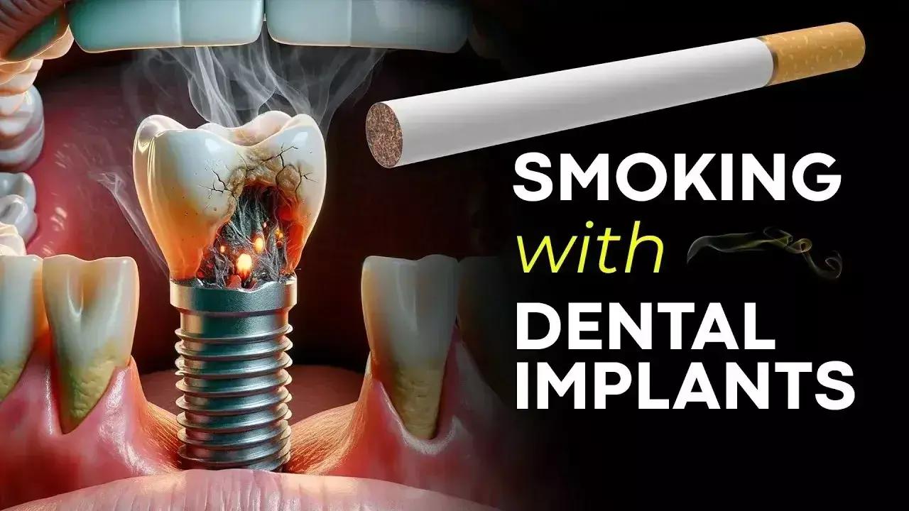 Smoking Associated With Early Dental Implant Failure, Reports Research