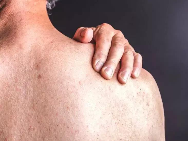 Lansoprazole Use Linked With Subsequent Psoriasis Risk: Study