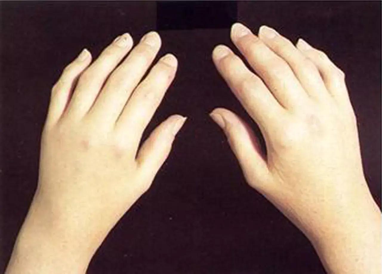Antibiotics Exposure In Early Life Linked With Juvenile Idiopathic Arthritis: Study