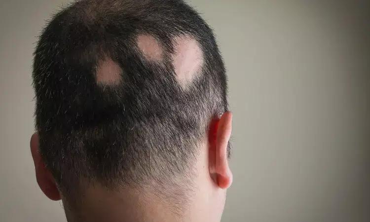 Active Ritlecitinib May Improve Hair Growth In Patients With Alopecia Areata: Study