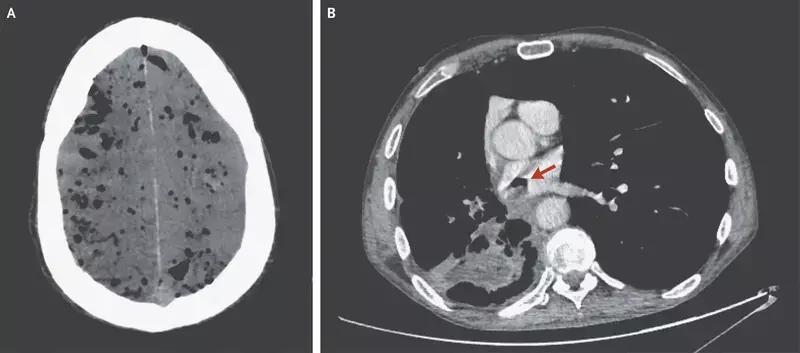 Rare Case Of Pneumocephalus Due To A Bronchoatrial Fistula Reported In NEJM
