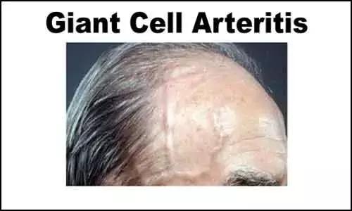 British Society For Rheumatology Releases Guideline On Management Of Giant Cell Arteritis