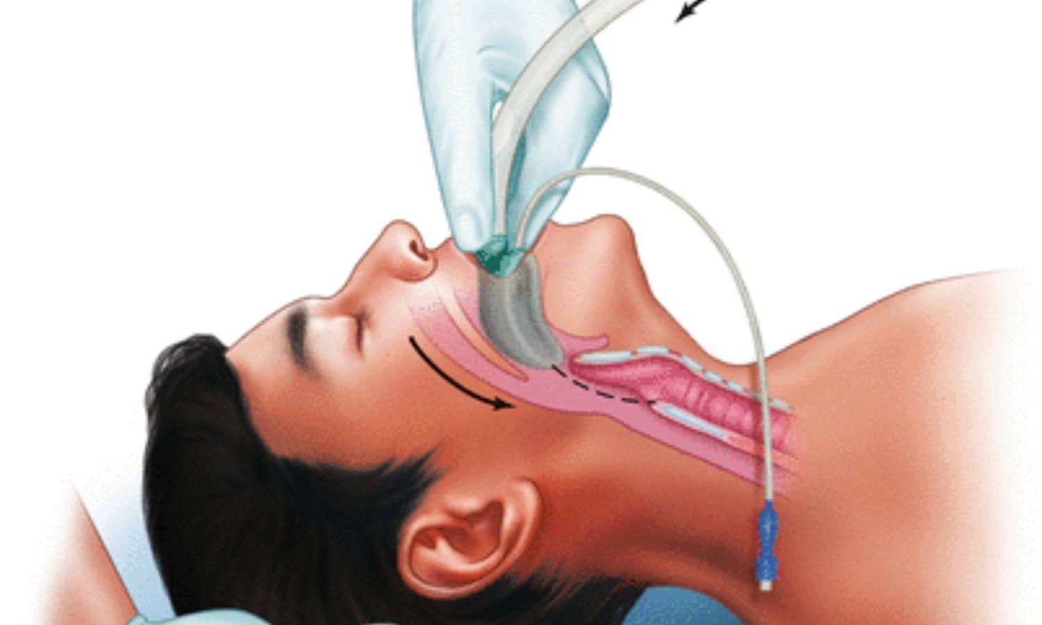 Study Evaluates Optimisation Of Table Height For Supraglottic Airway Device Insertion