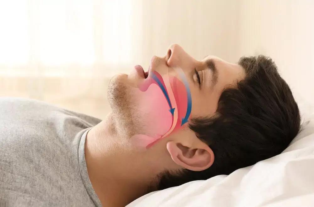 Sleep Apnea Severity Not Linked To Blood Sugar Control In T2DM
