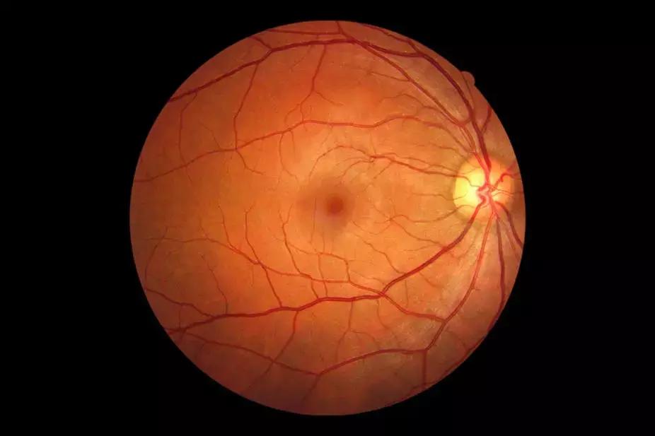 Intravitreal Infusion Of Methotrexate During Pars Plana Vitrectomy Safe Adjuvant In Rhegmatogenous RD