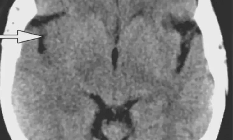 TyG Index Significantly Associated With Stroke Recurrence And High Mortality