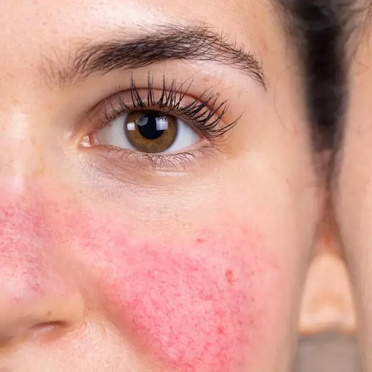 Vasodilators May Emerge As Potential Treatment Option For Rosacea: Study