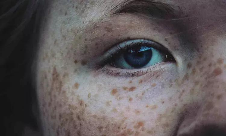 577-Nm Yellow Laser Effective, Safe, And Well-Tolerated Device In Treatment Of Freckles And Lentigines, Finds Study