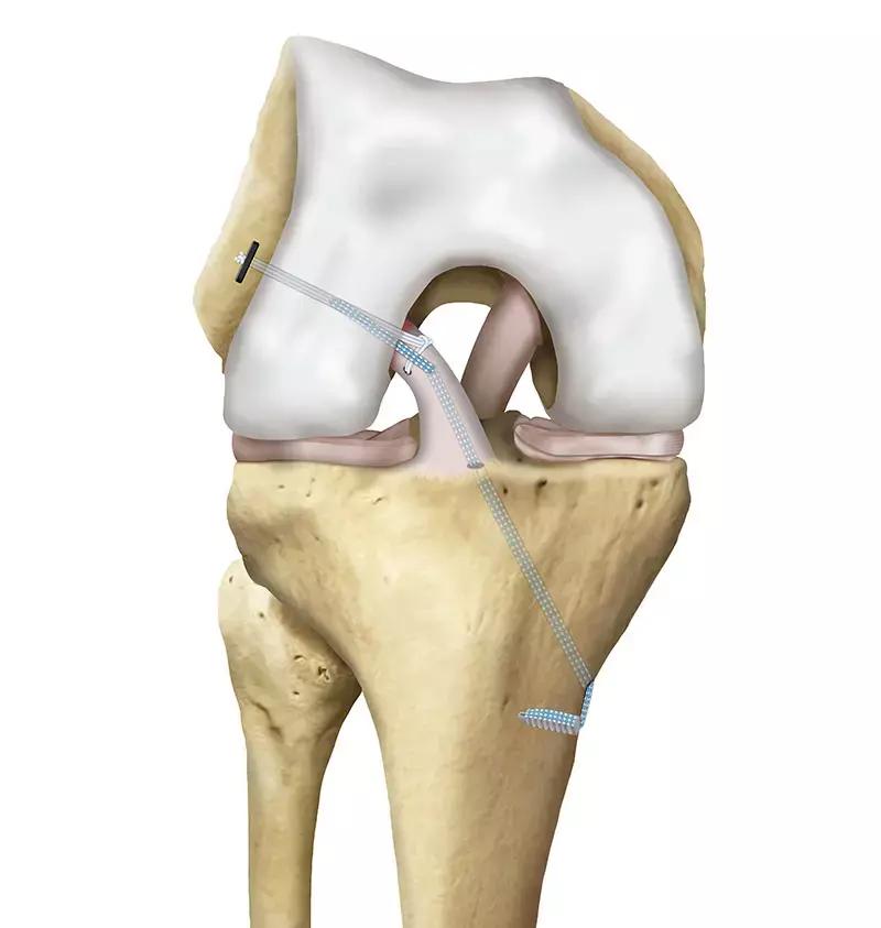 ACL Repair With Internal Bracing Effective Option To ACL Reconstruction For Acute Proximal Tears