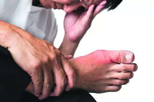 Covid-19 Related Mortality More Common In Women With Gout: Lancet