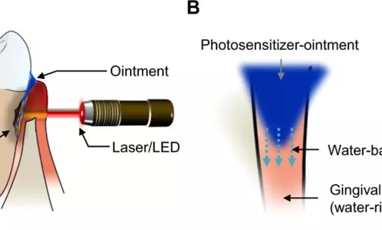 Transgingival Antimicrobial Photodynamic Therapy May Reduce Microbial Colonies During Periodontal Maintenance