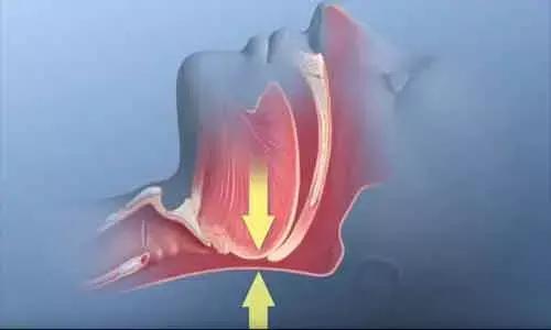 Untreated Sleep Apnea Patients More Likely To Be Hospitalized For Flu Infection