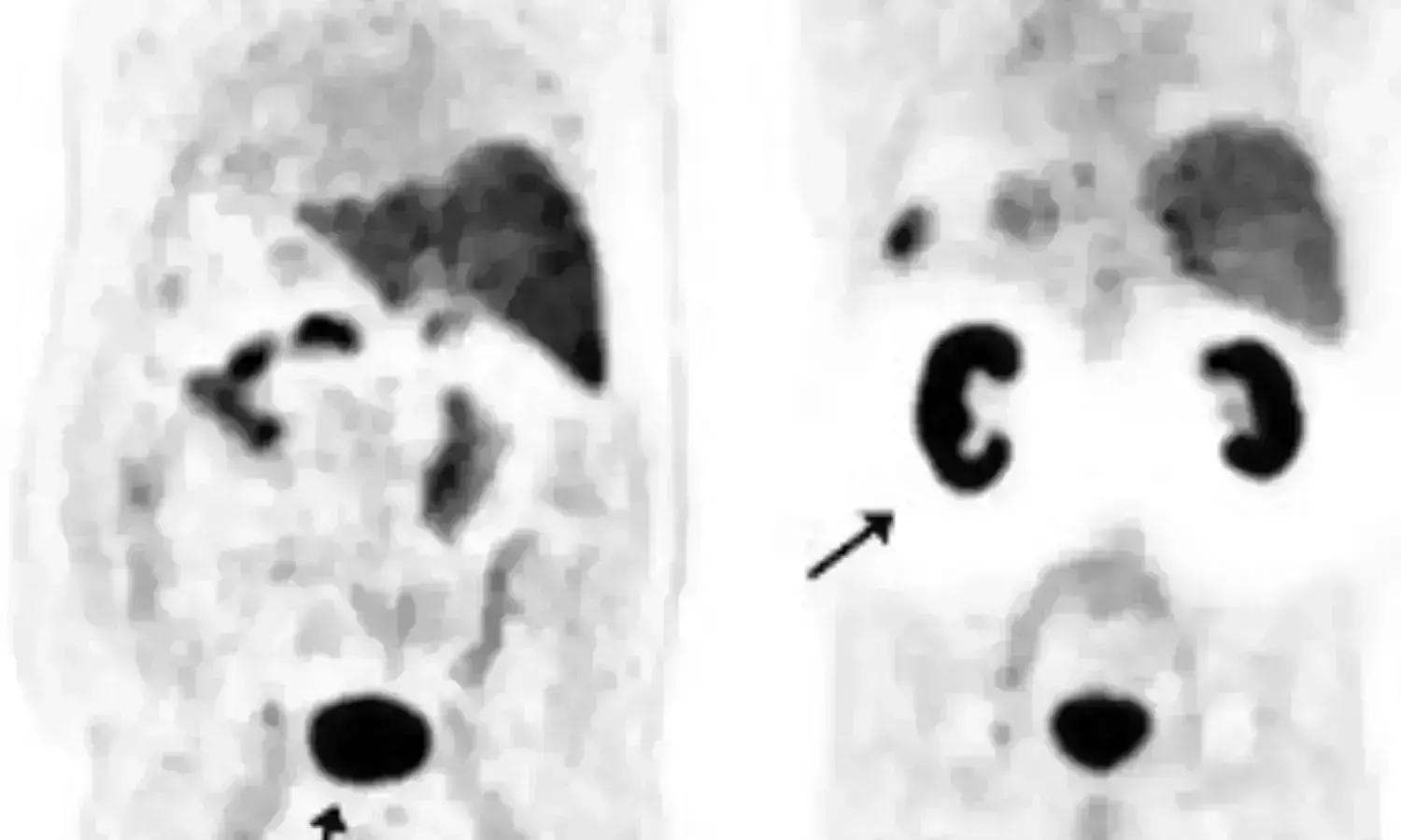 Increased PSMA PET/CT May Predict Chemotherapy Response In Metastatic Prostate Cancer: Study