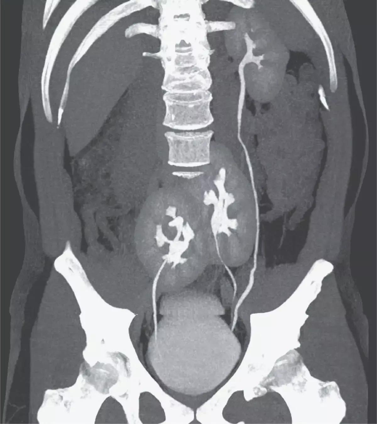 Rare Case Of Three Kidneys Reported In NEJM