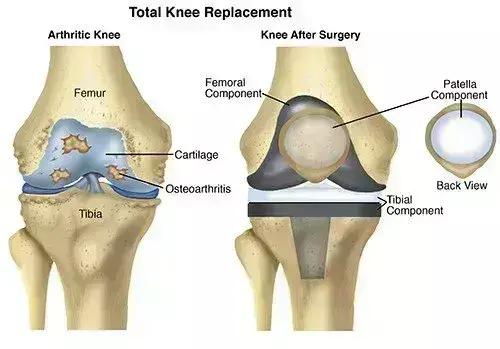 Case Of Total Knee Arthroplasty For Knee Osteoarthritis Associated With Abnormal Patellar Tendon Deformity: A Report